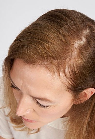 אישה מציגה שיער דליל לפני שימוש במוצרי טיפוח שיער אלביב Growth Booster