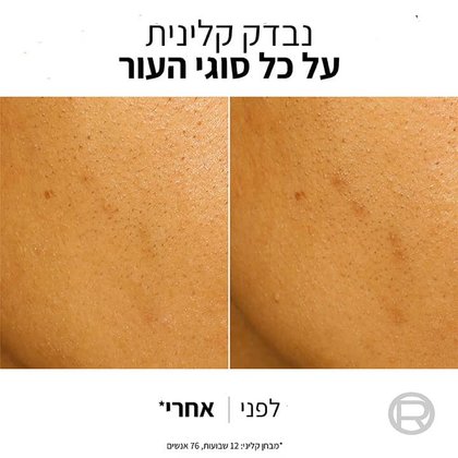 נבדק קלינית על כל סוגי העור. הדמיה של לפני ואחרי השימוש במסכת פילינג. מבחן קליני אחרי 12 שבועות. 76 אנשים
