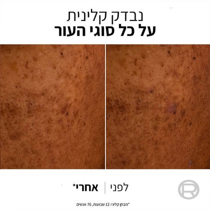 נבדק קלינית על כל סוגי העור. הדמיה של לפני ואחרי השימוש בתחליב הגנה. מבחן קליני אחרי 12 שבועות. 76 אנשים