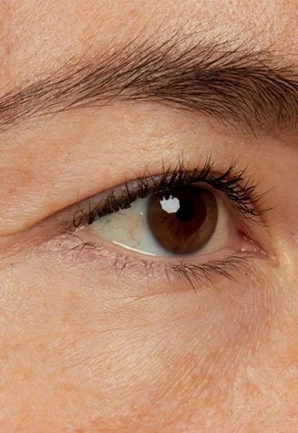 אישה מציגה את עור הפנים באזור העיניים אחרי השימוש בסרום עיניים Revitalift Filler