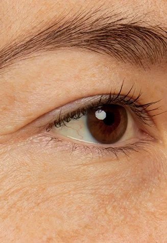 אישה מציגה את עור הפנים באזור העיניים לפני שימוש בסרום עיניים Revitalift Filler